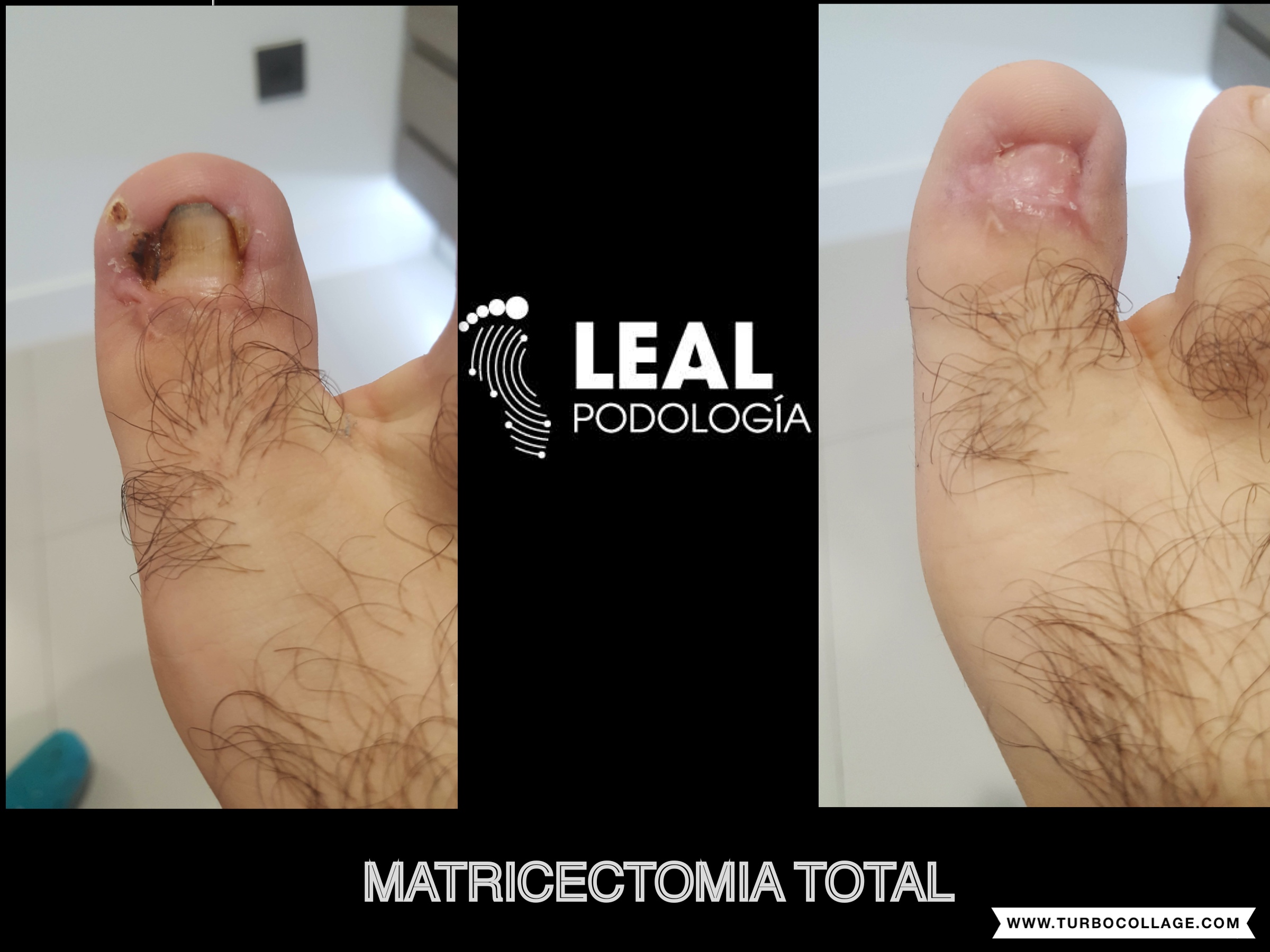 Matricectomia total