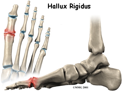 foot hallux rigidus intro01